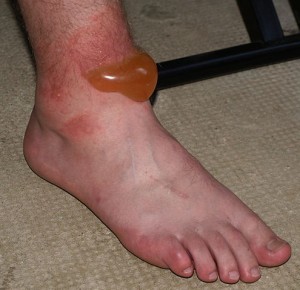 Blister caused by Roundup exposure. By Tael (own work) via Wikimedia Commons.